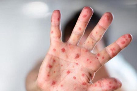 حالات إصابة بوحمرون حسب بلاغ وزارة الصحة والحماية الاجتماعية